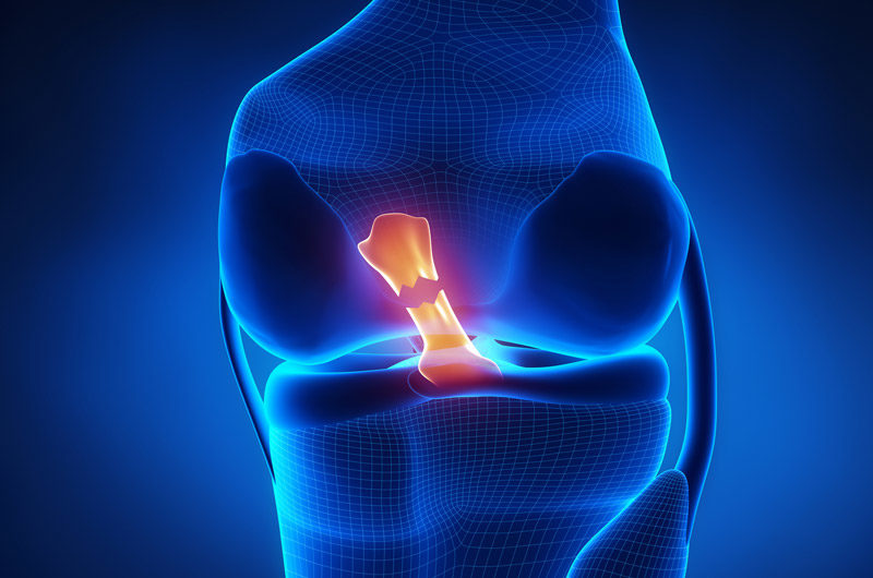 Digital-illustration-of-a-torn-ACL