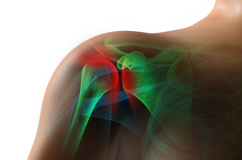 3D-illustration-of-AC-joint-injury