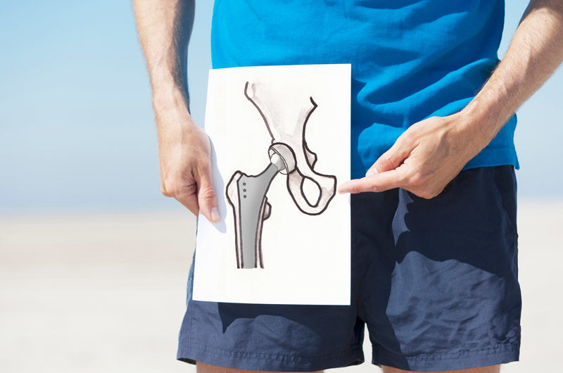 Male-patient-holding-illustration-of-total-hip-arthroplasty