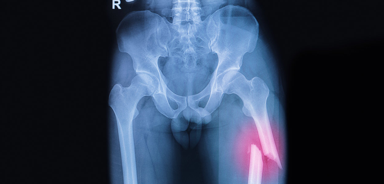 X-ray-scan-of-fractured-femur